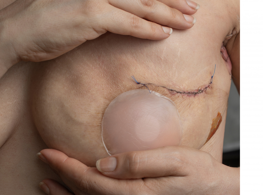 Удаление груди: показания, подготовка к операции, осложнения - МЕДСИ